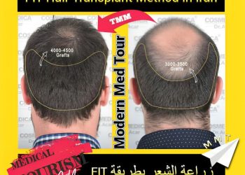 زراعة الشعر بتقنية FIT في إيران