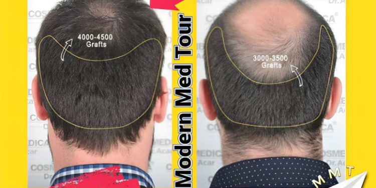 زراعة الشعر بتقنية FIT في إيران