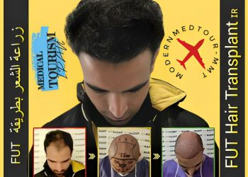 کاشت مو با تکنیک FUT