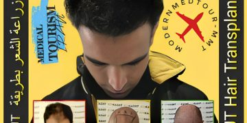 کاشت مو با تکنیک FUT