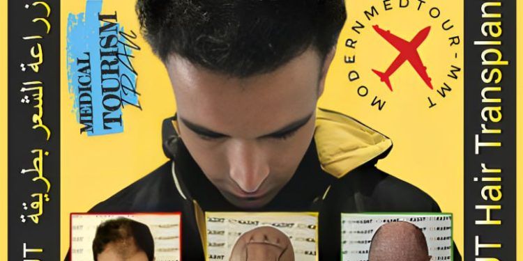 کاشت مو با تکنیک FUT