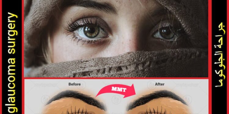 جراحات الجلوكوما: أنواعها وتعاريفها