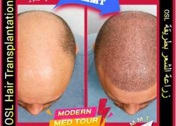 زراعة الشعر بتقنية OSL في إيران