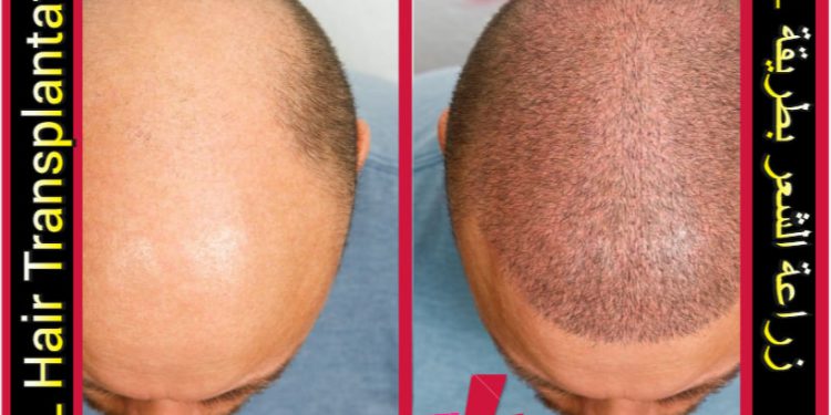 زراعة الشعر بتقنية OSL في إيران