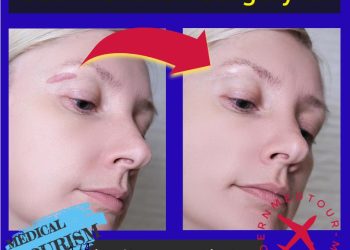 جراحة تجديد الندبة (Scar Revision Surgery) في إيران