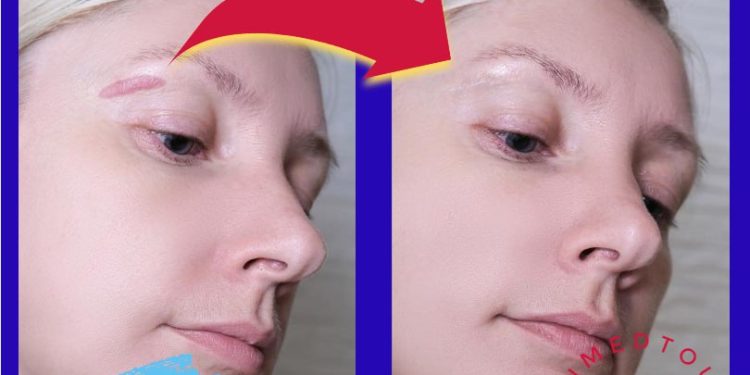  جراحة تجديد الندبة (Scar Revision Surgery) في إيران