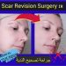  جراحة تجديد الندبة (Scar Revision Surgery) في إيران