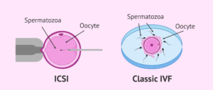 الحقن المجهري للحيوانات المنوية داخل البلازمة (ICSI)