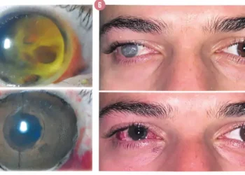 الكيراتوبغمنتشن لأهداف طبية: حل مبتكر لاستعادة المظهر الطبيعي للعين