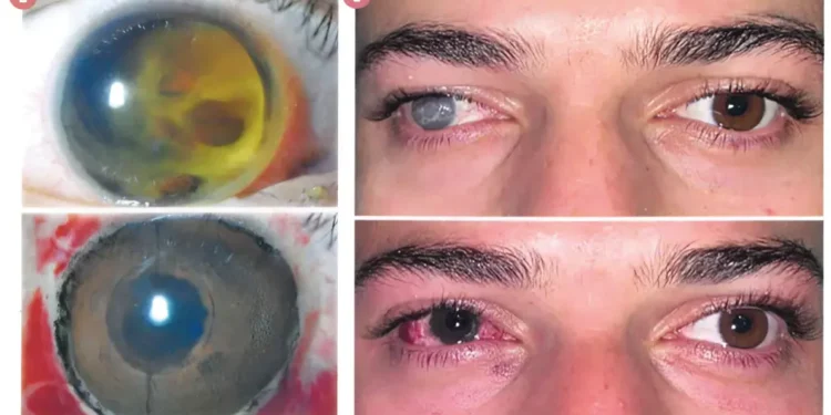 الكيراتوبغمنتشن لأهداف طبية: حل مبتكر لاستعادة المظهر الطبيعي للعين