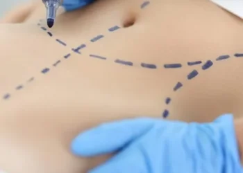 Абдоминопластика дар Эрон